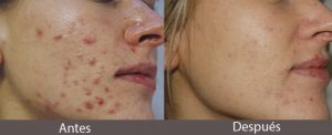 tratamiento laser afecciones acne juvenil