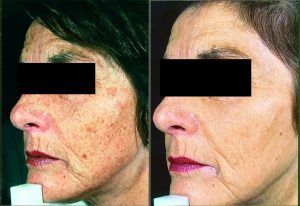 tratamiento laser rejuvenecimiento cara facial