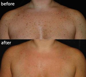 tratamiento laser rejuvenecimiento piel cuerpo