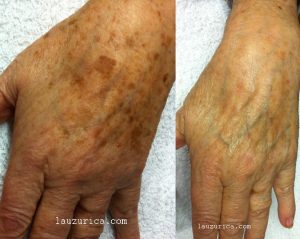 tratamiento laser rejuvenecimiento piel manos